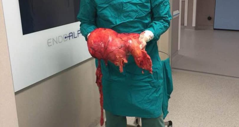 Ilustracija članka: U Sarajevu ženi odstranili tumor od 11,4 kilograma