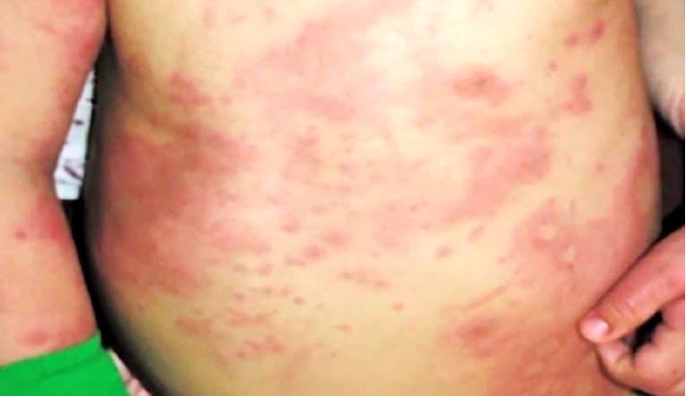 Ilustracija članka: Epidemija ospica brzo se širi Sarajevom. Ljudi ne žele cijepiti djecu