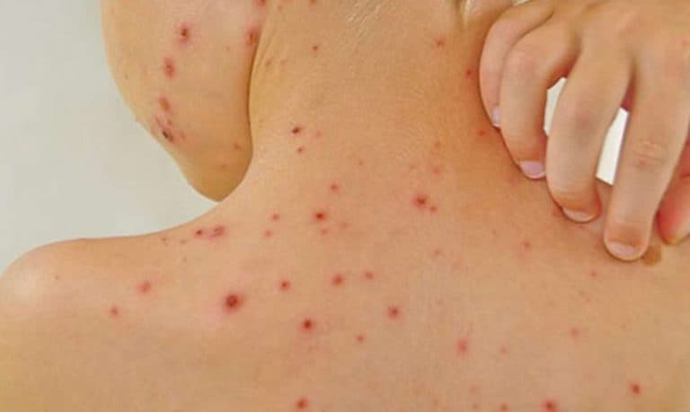 Ilustracija članka: Epidemija u FBiH: Prošle i pretprošle godine po 40 oboljelih od ospica, a ove 700