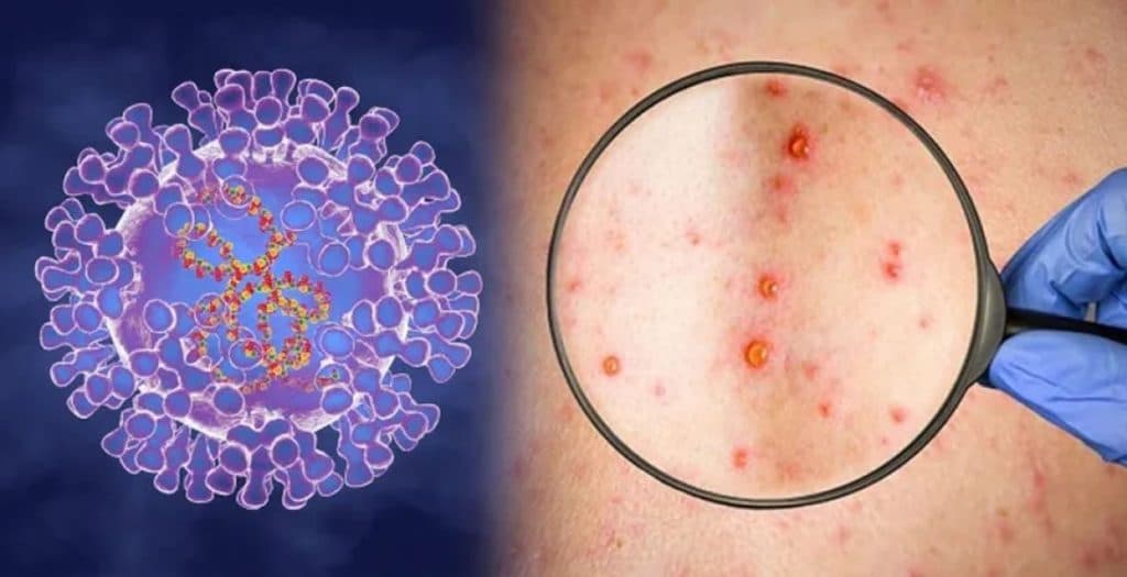 Ilustracija članka: Možemo očekivati da se u skorije vrijeme majmunske boginje pojave i u BiH