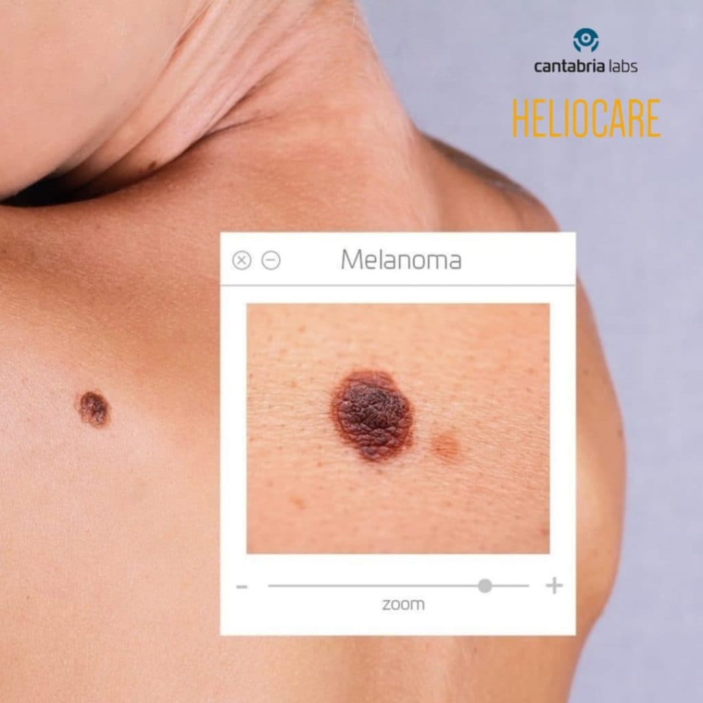 Ilustracija članka: Danas je u Grudama besplatan pregled madeža. Pridruži se borbi protiv melanoma